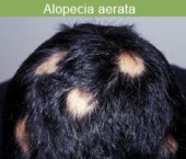 alopecia-aerata