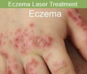 eczemalaser