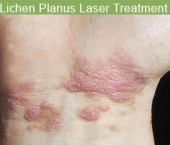 litchenplanus