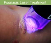 psoriasislaser