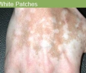 white_patches