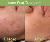 acnescar