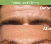 botox