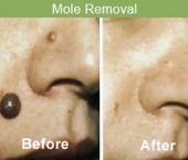 moleremoval