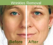 wrinklesremoval